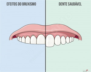 Imploodonto - Bruxismo é uma desordem funcional que se caracteriza pelo  ranger ou apertar dos dentes durante o sono. Essa pressão pode provocar  desgaste e amolecimento dos dentes. Nos casos mais graves